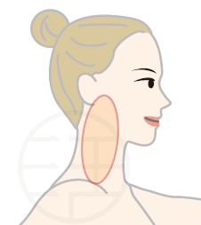 突発性難聴の原因として考えられる側頚部の緊張