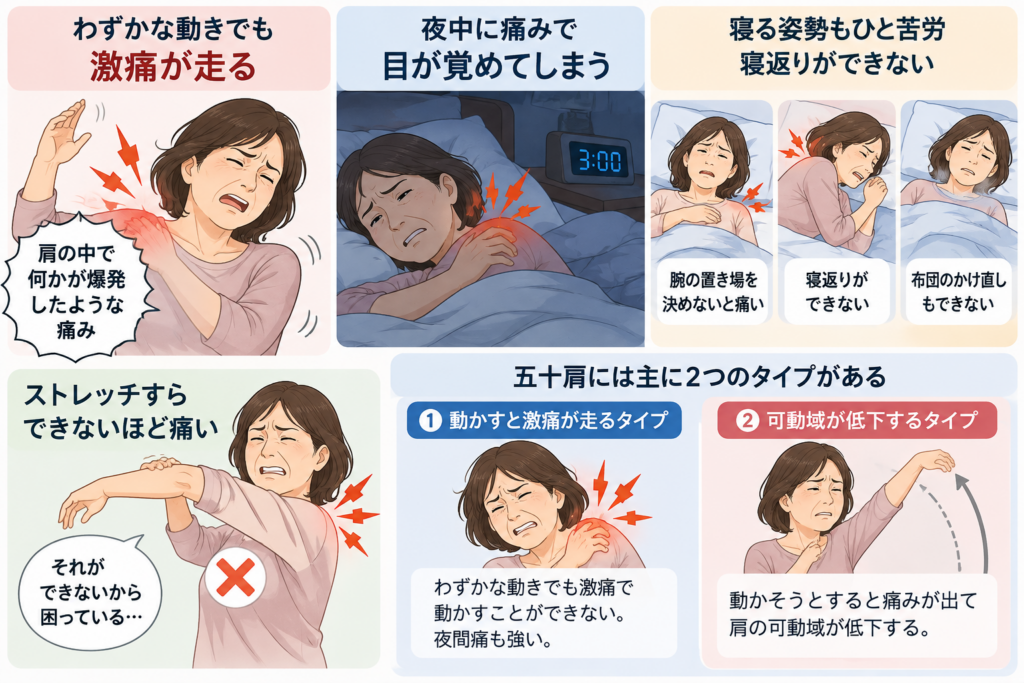 五十肩の激痛と夜間痛解説